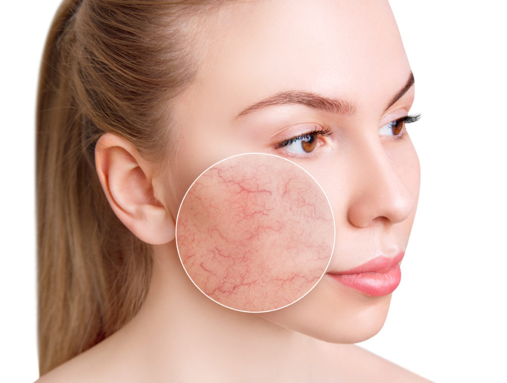 What Is The Main Cause Of Rosacea