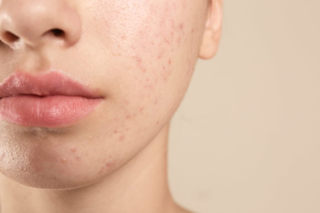 What Kind Of Treatment Works For Acne Scars