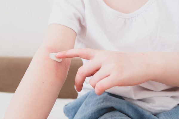 Eczema (Atopic Dermatitis) Causes, Treatment & Symptoms