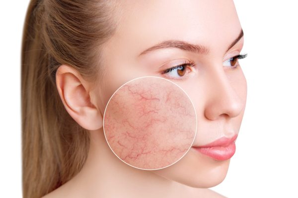 What Is The Main Cause Of Rosacea