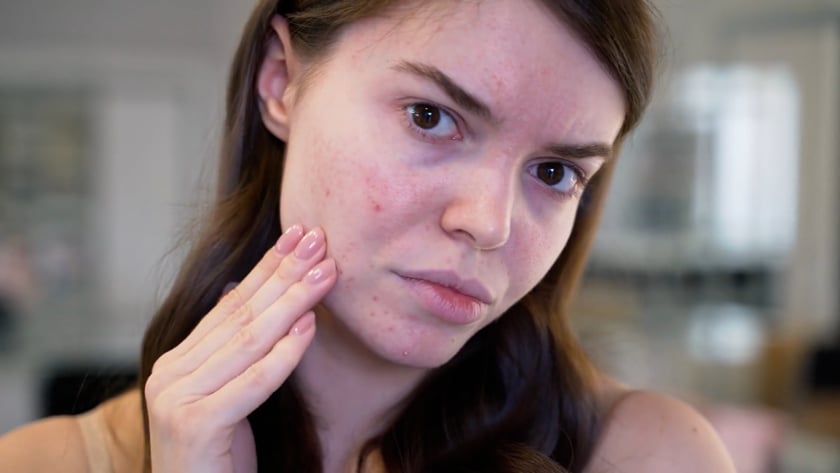 Acne Services in Slc UT 2 1681607950 a2157cc6fd181e4f58e93a91f1e92afe4f4282cc7e6b551a49a1652960db5880 d 840?region=us