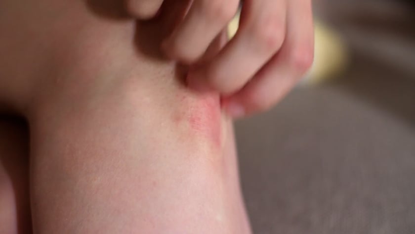 Psoriasis Treatment in SLC UT 2 1681613692 33fbb3f39b1f6b05b810291e709f9a1c350ef2db01b9e6b3d97149751e3f0ab1 d 840?region=us