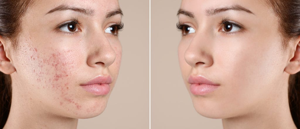 What Is The Main Cause Of Acne Vulgaris 1 What Is The Main Cause Of Acne Vulgaris