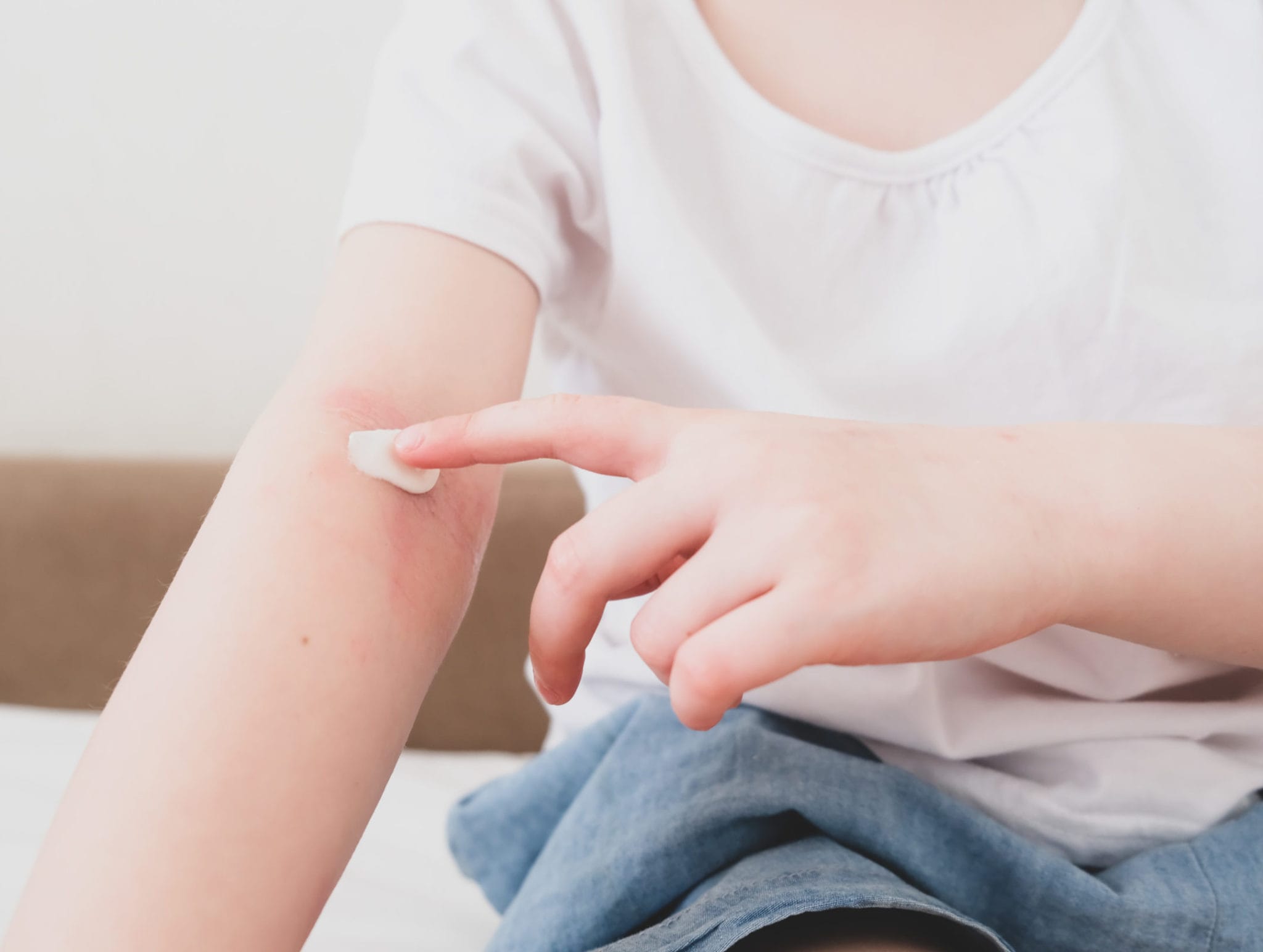 Eczema (Atopic Dermatitis) Causes, Treatment & Symptoms