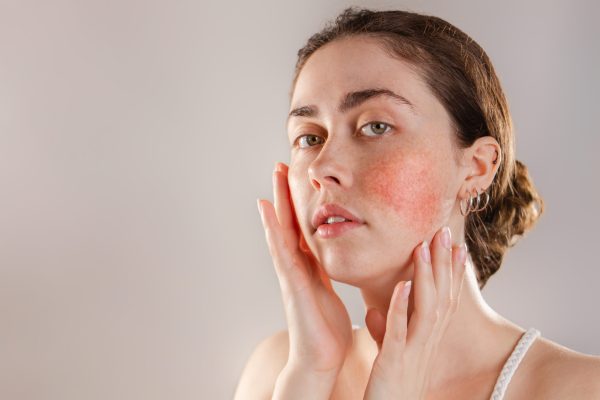 Rosacea Treatments, Types, Causes, And Symptoms